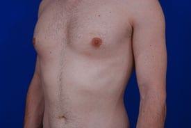 Gynecomastia Surgery Before & After Image