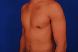 Gynecomastia Surgery Before & After Image