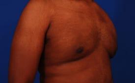 Gynecomastia Surgery Before & After Image
