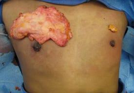 Gynecomastia Surgery Before & After Image