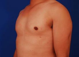 Gynecomastia Surgery Before & After Image