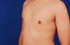 Gynecomastia Surgery Before & After Image