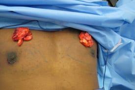 Gynecomastia Surgery Before & After Image