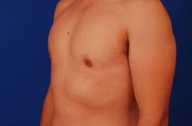 Gynecomastia Surgery Before & After Image