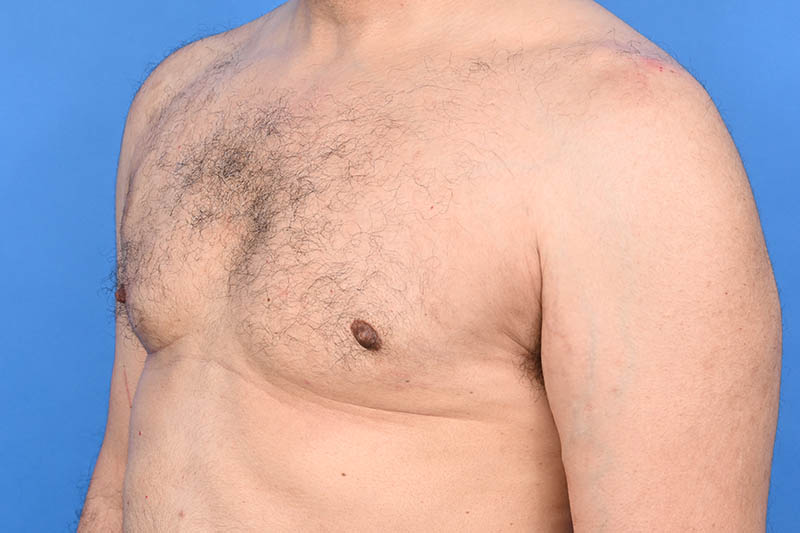 Gynecomastia Surgery Before & After Image