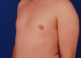 Gynecomastia Surgery Before & After Image