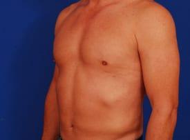 Gynecomastia Surgery Before & After Image