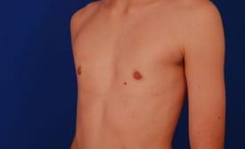 Gynecomastia Surgery Before & After Image
