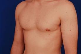 Gynecomastia Surgery Before & After Image