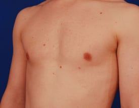 Gynecomastia Surgery Before & After Image
