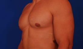Gynecomastia Surgery Before & After Image