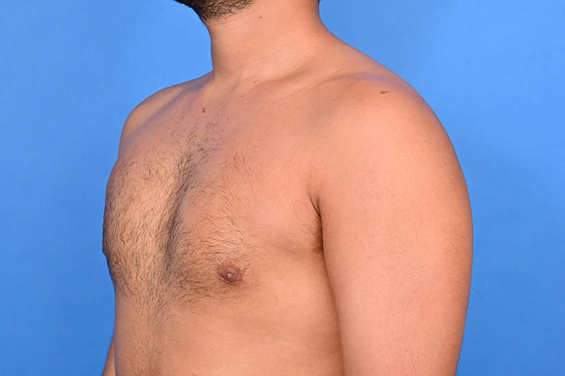Gynecomastia Surgery Before & After Image