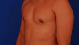 Gynecomastia Surgery Before & After Image