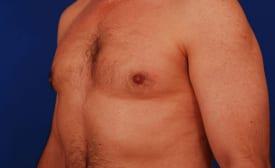 Gynecomastia Surgery Before & After Image