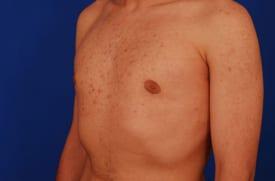 Gynecomastia Surgery Before & After Image