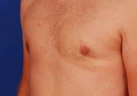 Gynecomastia Surgery Before & After Image