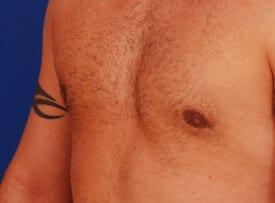 Gynecomastia Surgery Before & After Image
