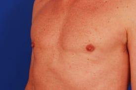 Gynecomastia Surgery Before & After Image