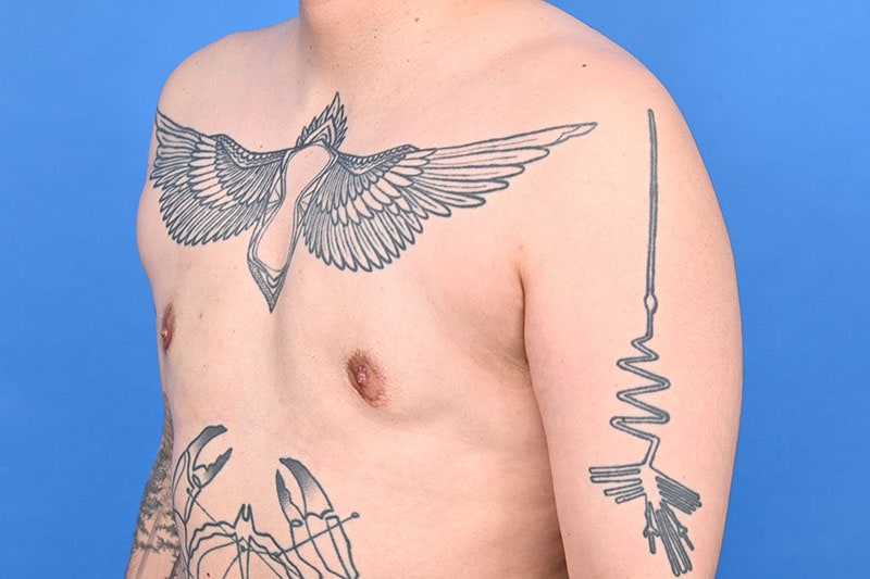 Gynecomastia Surgery Before & After Image