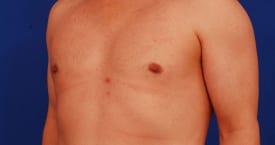 Gynecomastia Surgery Before & After Image