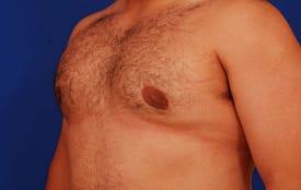 Gynecomastia Surgery Before & After Image