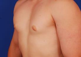 Gynecomastia Surgery Before & After Image