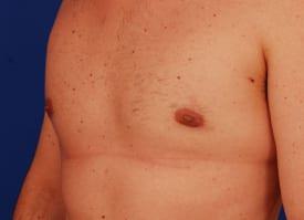Gynecomastia Surgery Before & After Image