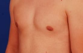 Gynecomastia Surgery Before & After Image