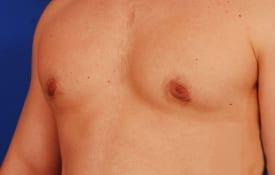 Gynecomastia Surgery Before & After Image