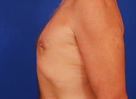 Gynecomastia Surgery Before & After Image