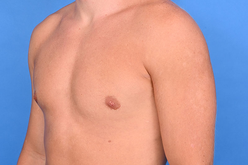 Gynecomastia Surgery Before & After Image