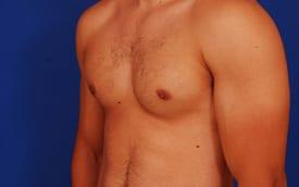 Gynecomastia Surgery Before & After Image