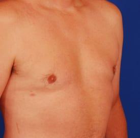 Gynecomastia Surgery Before & After Image