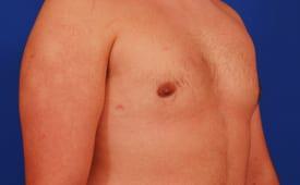 Gynecomastia Surgery Before & After Image