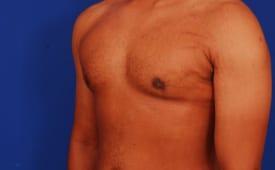 Gynecomastia Surgery Before & After Image