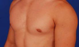 Gynecomastia Surgery Before & After Image