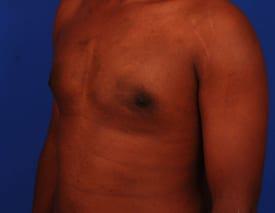 Gynecomastia Surgery Before & After Image