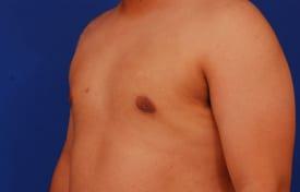Gynecomastia Surgery Before & After Image