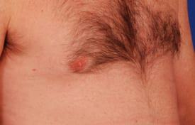 Gynecomastia Surgery Before & After Image
