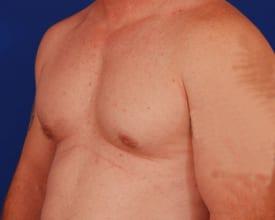 Gynecomastia Surgery Before & After Image