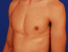 Gynecomastia Surgery Before & After Image