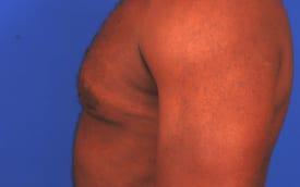 Gynecomastia Surgery Before & After Image