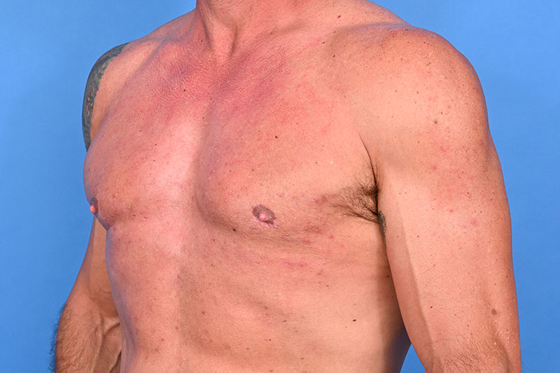 Gynecomastia Surgery Before & After Image