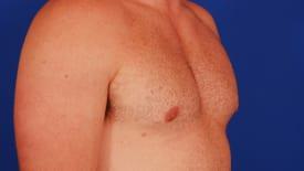 Gynecomastia Surgery Before & After Image