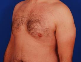 Gynecomastia Surgery Before & After Image
