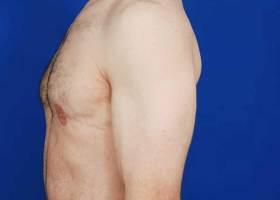 Gynecomastia Surgery Before & After Image