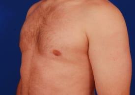 Gynecomastia Surgery Before & After Image