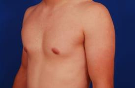 Gynecomastia Surgery Before & After Image