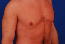 Gynecomastia Surgery Before & After Image