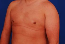 Gynecomastia Surgery Before & After Image